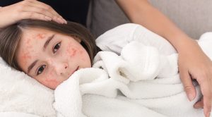 Anak Terkena Campak, Bolehkah Beraktivitas Di Luar?