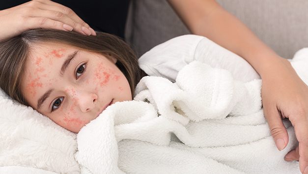 Anak Terkena Campak, Bolehkah Beraktivitas Di Luar?